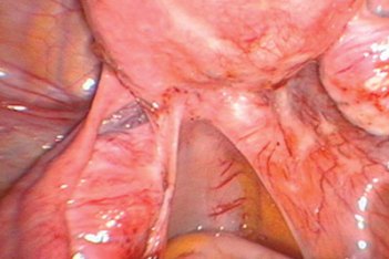 uterine-cavity.jpg